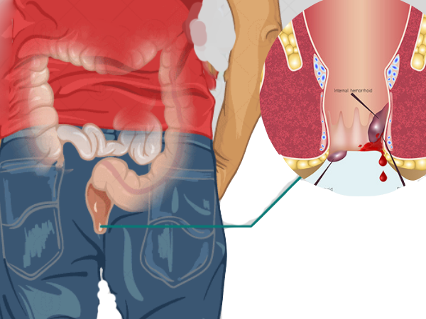 Anal Fistula Bhagandar Cure